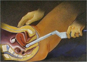 Transvaginal Sonogram Transvaginal Sonogram